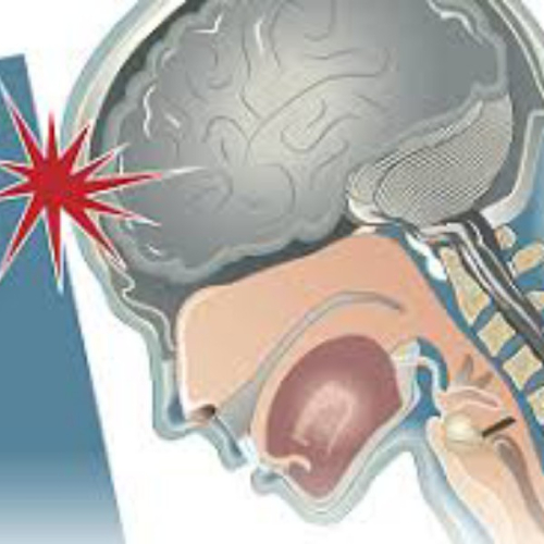 Що таке струс мозку? Симптоми, причини та лікування струс мозку