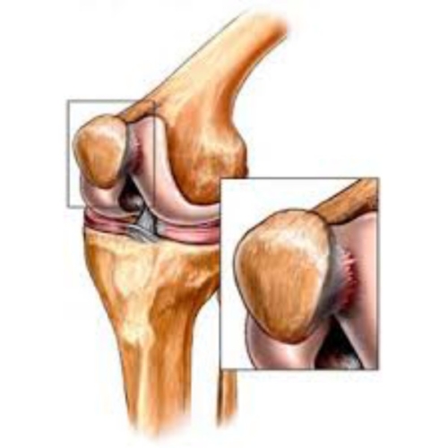 Пошкодження хряща у колінному суглобі